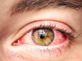 οφθαλμικές αλλεργίες