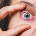 Μάτι που πάσχει από βλεφαρίτιδα